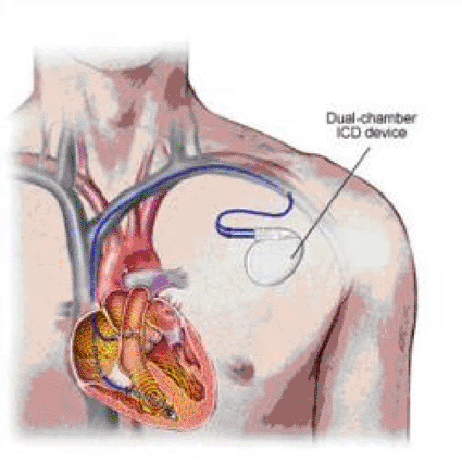 Imagen: Representación esquemática de un desfibrilador implantado (Foto cortesía del Centro Médico de la Universidad de Rochester). Imagen: Representación esquemática de un desfibrilador implantado (Foto cortesía del Centro Médico de la Universidad de Rochester).